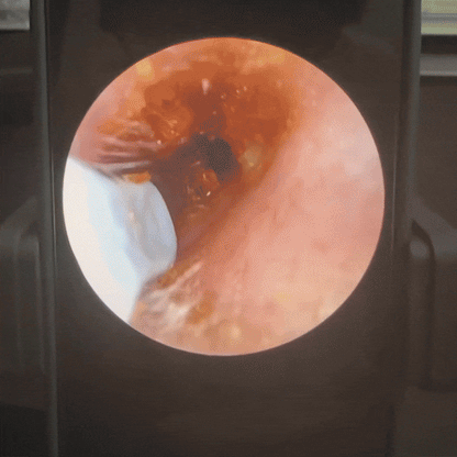 NE3-D – Ohrreiniger mit Kamera